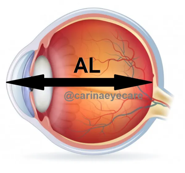 Diagram illustrating axial length measurement in the eye