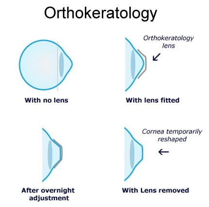 Difference of Orthokeratology